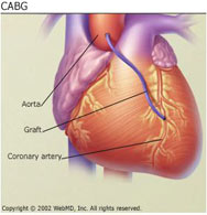 Coronary Artery Bypass Surgery at the Division of Cardiothoracic Surgery, SUNY Downstate Medical Center